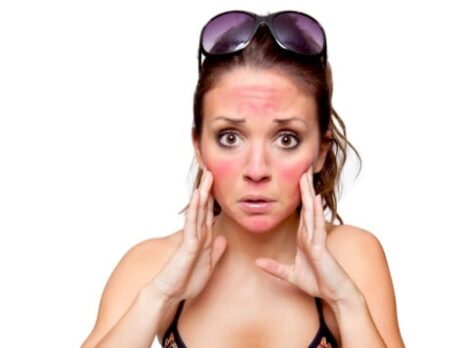 Woman with a sunburnt face