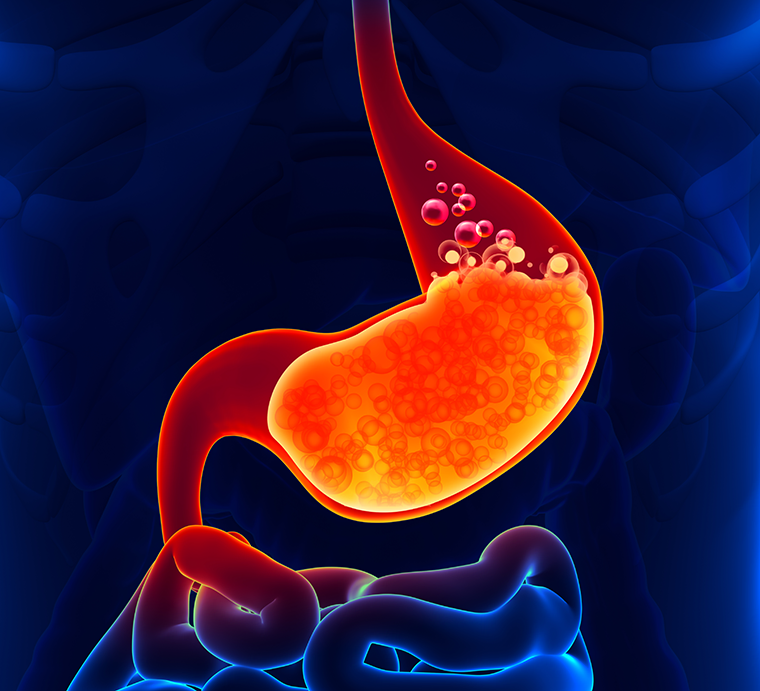 An illustration of gastric acid building up in the stomach